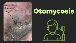 Otomycosis  Ear Nose Throat [upl. by Nuris168]