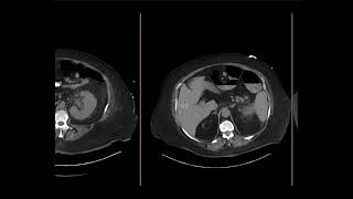 Pyelonephritis with abscess [upl. by Hafler]