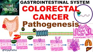 Colorectal carcinoma  Epidemiology risk factors amp Pathogenesis [upl. by Suhcnip]