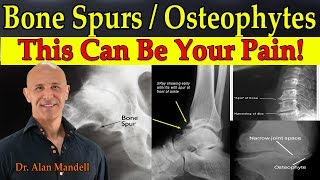 Bone SpursOsteophytes  This Can Be Your Pain  Dr Mandell [upl. by Todhunter]