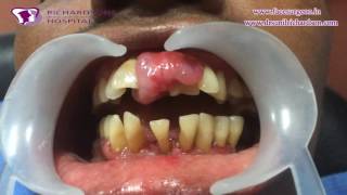 Massive Epulis Removal Treatment  Dental Videos showing Oral Surgery [upl. by Allsopp337]