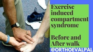 Exercise Induced Compartment Syndrome Signs and Symptoms [upl. by Soloman]