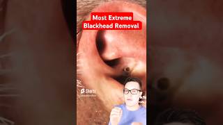 Most Extreme BLACKHEAD REMOVAL  Major Ear Blackhead Popping shorts [upl. by Jessabell]