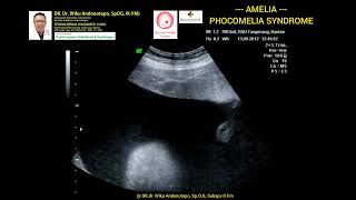 Amelia  Phocomelia syndrome [upl. by Erdnael429]