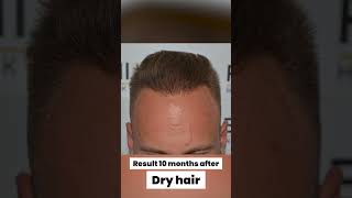 Norwood 6  Hair Transplant  FueGenix  Dr Munib Ahmad [upl. by Assela]