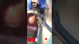 Forceps Extraction of upper first premolar [upl. by Obola]