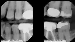 Straumann  Fixed restoration with 46 implants all straight [upl. by Leeban]