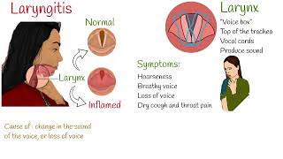 Laryngitis  Symptoms causes and treatment [upl. by Rebmyk]