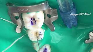 Mandibular second premolar  Access cavity preparation  Endodontic [upl. by Sitto]