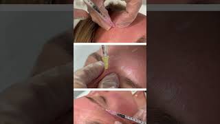 ¡Tratamiento suavizador de arrugas y lineas de expresión miriamclinic mesoterapiafacial [upl. by Ronal]