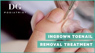 Ingrown toenail removal treatment [upl. by Notnarb]