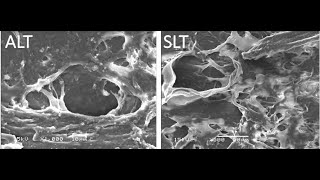 Selective Laser Trabeculoplasty Tips and Tricks Malik Y Kahook MD [upl. by Alya]