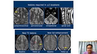 Imaging in Demyelinating disorders of CNS [upl. by Busiek]