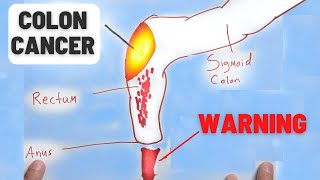 4 Warning Signs of Colon Cancer You Should NEVER Ignore [upl. by Brindle]