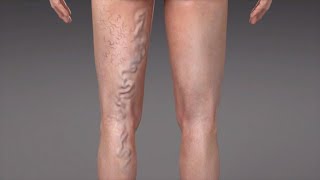 What are Varicose Veins [upl. by Tterrab]