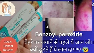 benzoyl peroxide gel 25  benzoyl peroxide gel Persol AC 25 review gel acne skincare [upl. by Ecinue868]