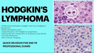 Hodgkin’s lymphoma pathology Quick revision for 2nd yr MBBS pathology examNEET PGNEXT [upl. by Brita197]