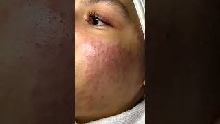 Cystic acne and blackheads removal  Newest pimple pops for 2022 [upl. by Inihor]