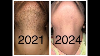 147 hours Electrolysis Hair Removal  Permanent Facial Hair Removal Expectations  PCOS Hirsutism [upl. by Dragone748]