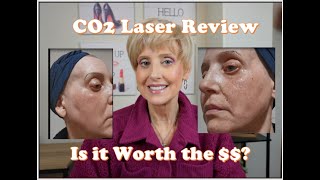 CO2 Laser Resurfacing Review Is it Worth the [upl. by Bigot]