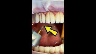 What You Need To Know About Veneers [upl. by Ecinahs]