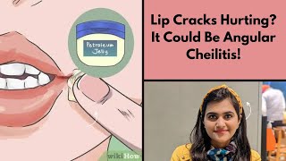 Lip Cracks Hurting It Could Be Angular Cheilitis [upl. by Hsetih642]