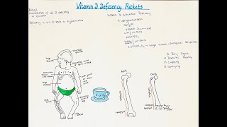 Rickets Vitamin D deficiency in children Bone manifestation signs and symptoms High yield info [upl. by Zulaledairam]