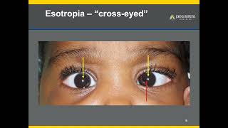 Strabismus  A Patient Guide to Misalignments of the Eyes [upl. by Htiel]