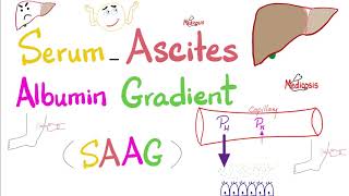 Serum Ascites Albumin Gradient SAAG  Peritoneal Effusion  Lab 🧪 [upl. by Chrysler]