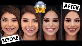 OUR CRAZY TEETH TRANSFORMATION  SHOCKING [upl. by Odin476]