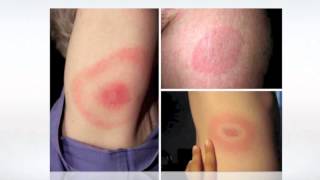 Lyme Disease Pictures  wikiSymptoms [upl. by Charlean]