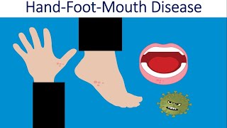 What is Hand Foot amp Mouth Disease  HFMD  Cause Symptoms Diagnosis amp Prevention of HFMD [upl. by Underwood]