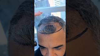 Rare hair transplant Balding behind the forelock post op vincihairclinic shorts [upl. by Adorne]