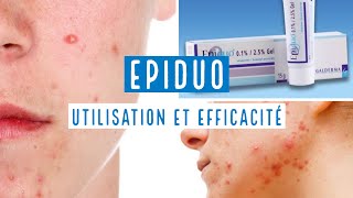 EPIDUO 0125  GEL [upl. by Olinad]