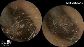 1545  Patient Still Felt Ear Was Blocked After Ear Wax Removal [upl. by Almeria]