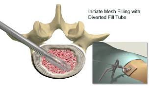 Spineology OptiLIF with the OptiMesh Expandable Interbody Fusion System [upl. by Anelat]