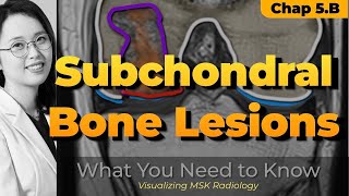 Chapter 5 B⎜Subchondral bone lesions ⎜Knee MRI⎜Visualizing MSK Radiology⎜Refer to timeline [upl. by Sadinoel]