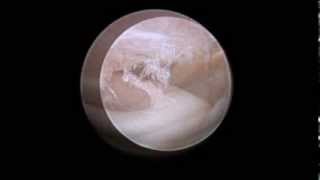 TMJ arthroscopic anatomy [upl. by Eicul]