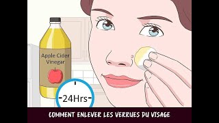 Comment enlever les verrues du visage [upl. by Vincents]