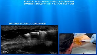 Ultrasound Guided Atypical Olecranon Bursitis Aspiration and Cortisone Injection by probeultrasound [upl. by Teirrah]