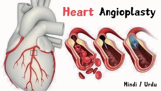 HEART Stent ANGIOPLASTY A LifeSaving Treatment for Narrowed Arteries Hindi Urdu animation [upl. by Anaek]