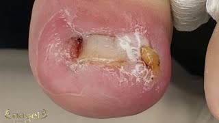 😱UNHA ENCRAVADA SÓ PARA OS FORTES nails ingrowntoenail [upl. by Euqinmod]