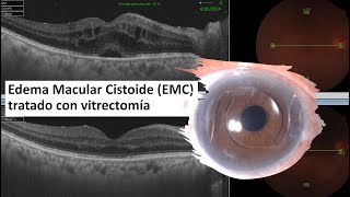 Edema Macular Cistoide EMC  Edema Macular Quístico  Vitrectomía  IrvineGass Syndrome [upl. by Lali]