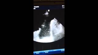 Thoracic USS  Complex pleural effusion [upl. by Portwin163]