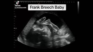 Frank Breech Presentation at 24 Weeks 5 Days Pregnant [upl. by Worthy]