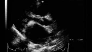 MS different aspectscalcified mitral stenosis [upl. by Nawek]