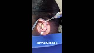 Removing Massive Earwax From Womans Ear [upl. by Ihsoyim181]