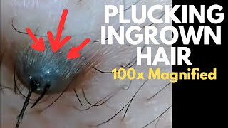 See How Ingrown Hair Gets Plucked at 100x Magnified Thick black hair with long wet amp slimy root [upl. by Mencher993]