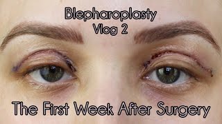 My Eyelid Surgery 1st Weeks of Recovery  Cosmetic Blepharoplasty Diary Part 2 [upl. by Patrizia]