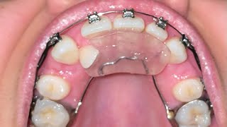 Upper Braces Time Lapse  15 Month Update  Adult Braces [upl. by Cobbie996]